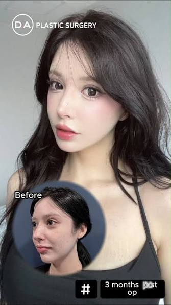 Three months after my procedure